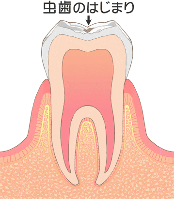 虫歯の最初期 C0（脱灰）