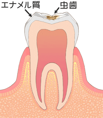 虫歯の初期 C1（歯の表面の虫歯・エナメル質）