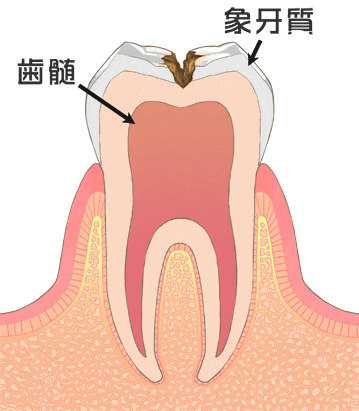 虫歯の中期 C2（歯の中の象牙質の虫歯）