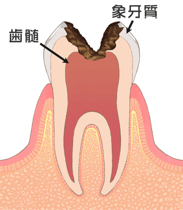 虫歯の後期 C3（神経まで進行した虫歯）