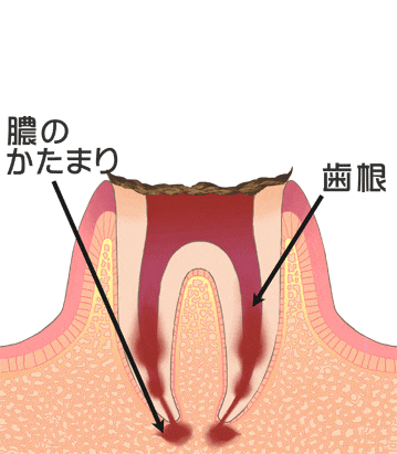 虫歯の末期 C4（歯の根まで進行した虫歯）