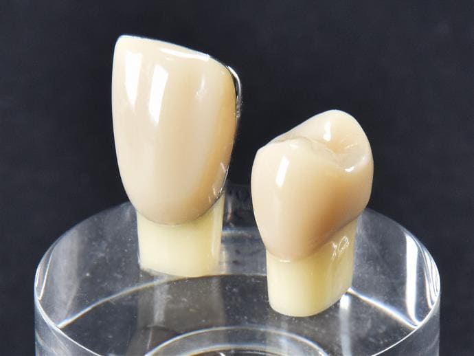 硬質レジン前装冠