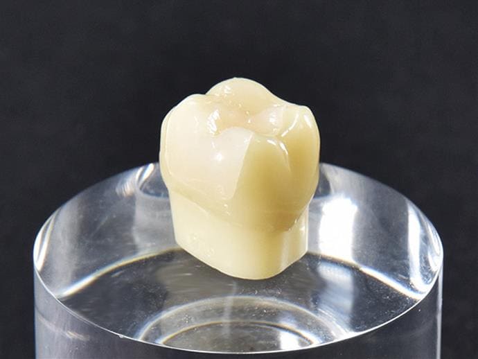 ジルコニア・インレー