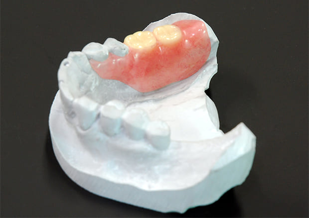 ノンクラスプデンチャー