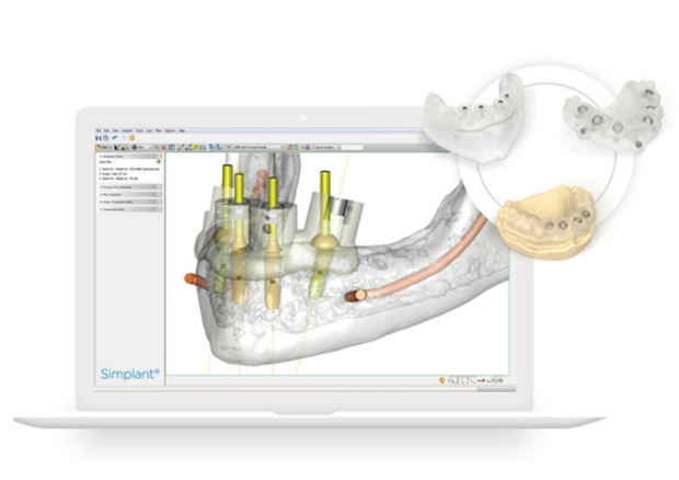 SimPlant（シムプラント）