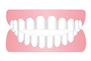 開咬、オープンバイト