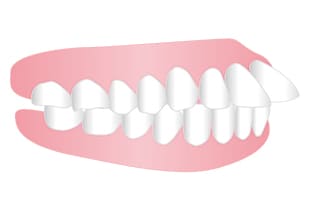 虫出っ歯、上顎前突