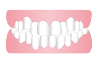 叢生、乱杭歯、八重歯