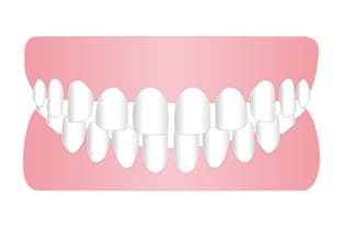 すきっ歯（空隙歯列弓）