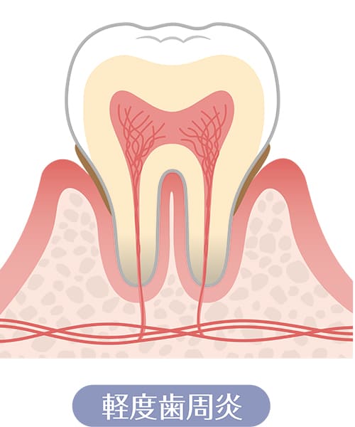 軽度歯周病（歯ぐきが腫れ、押すと血が出る）
