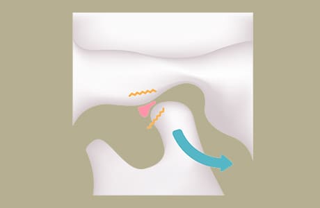 口を開けると下顎頭が変形した関節円板に引っかかる
